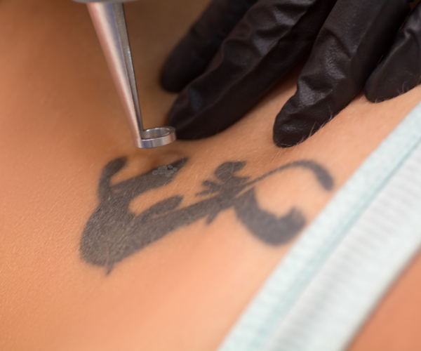 Laserborttagning av tatuering