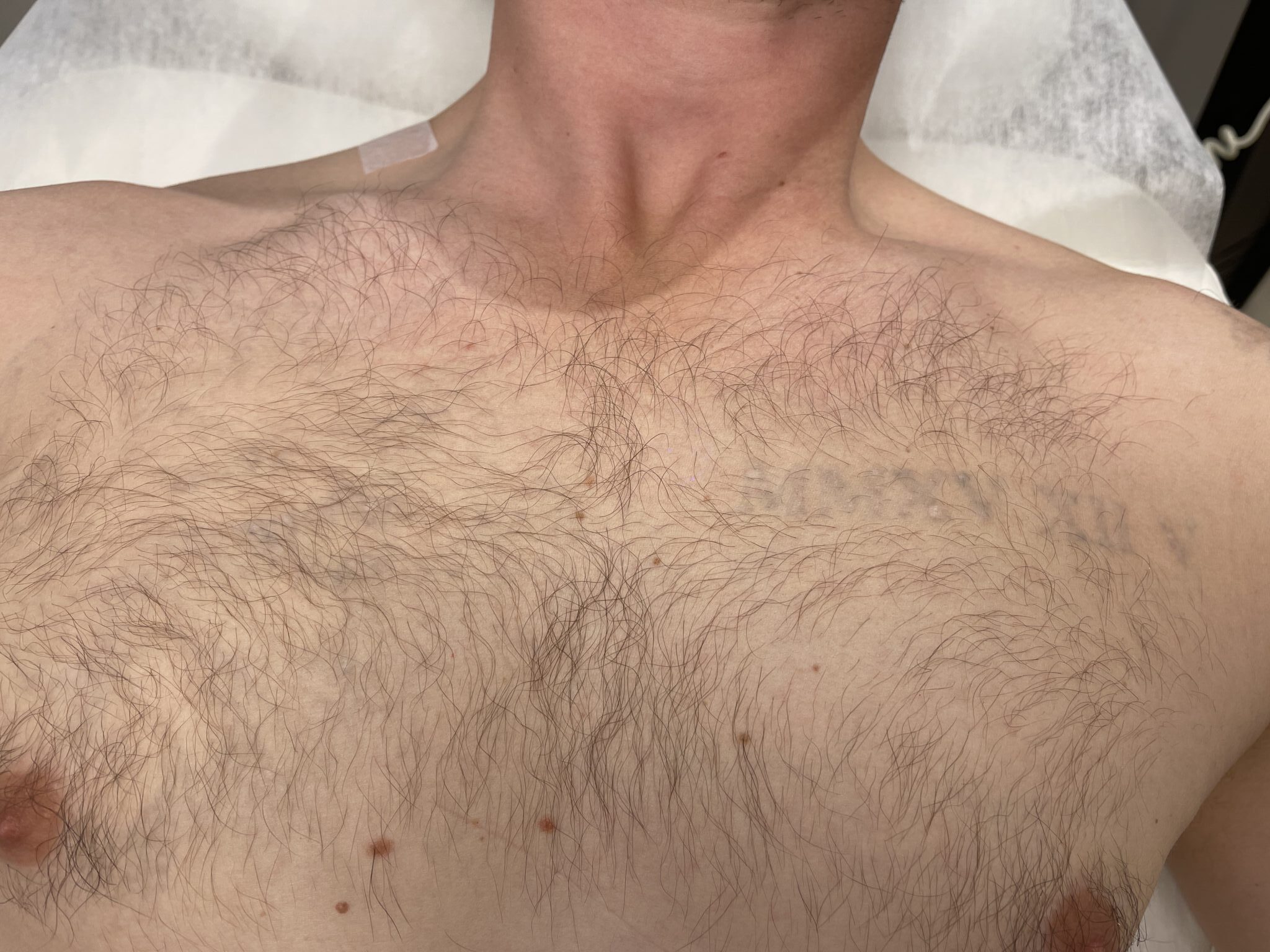 Efter tatueringsborttagning