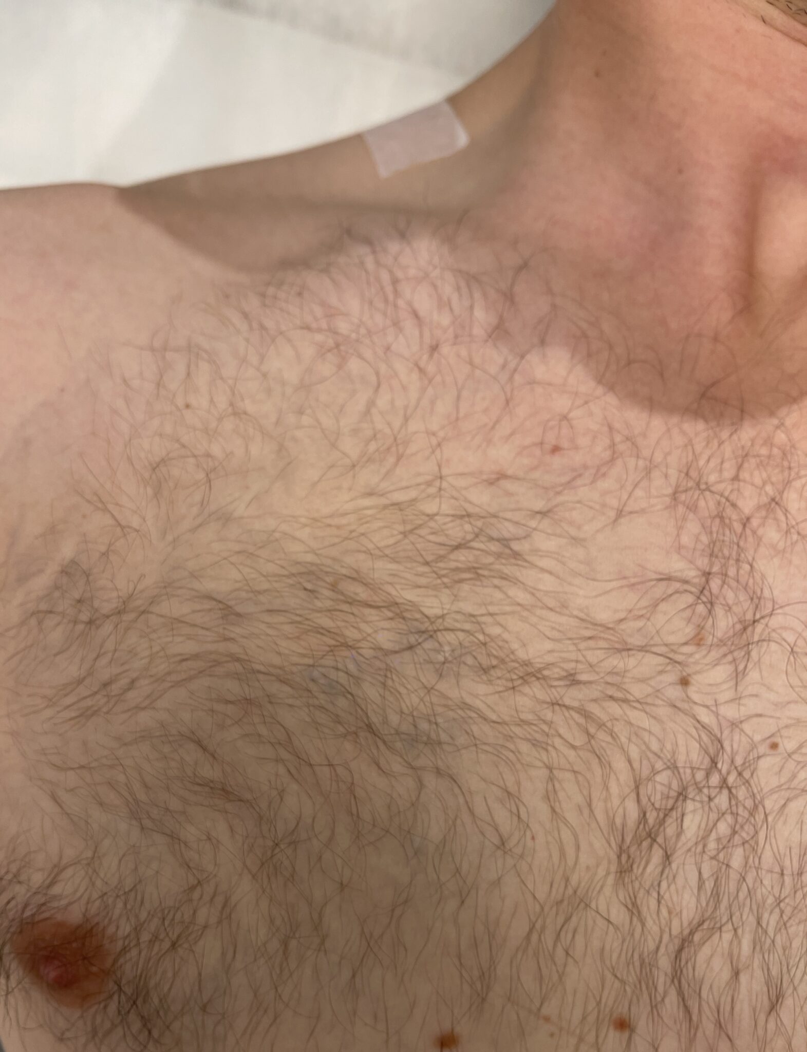 Efter tatueringsborttagning